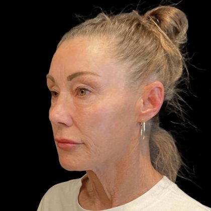 Facelift Before & After Patient #6492
