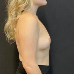 Breast Augmentation Before & After Patient #8198