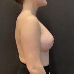 Breast Augmentation Before & After Patient #8198