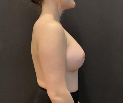 Breast Augmentation Before & After Patient #8198