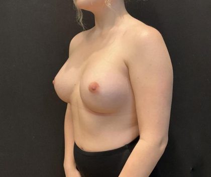 Breast Augmentation Before & After Patient #8198
