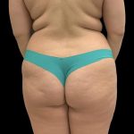 Brazilian Butt Lift Before & After Patient #8170