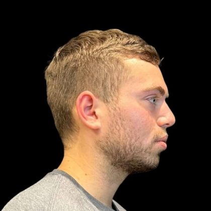 Rhinoplasty Before & After Patient #8159