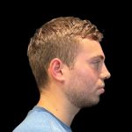 Rhinoplasty Before & After Patient #8159