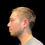 Rhinoplasty Before & After Patient #8159
