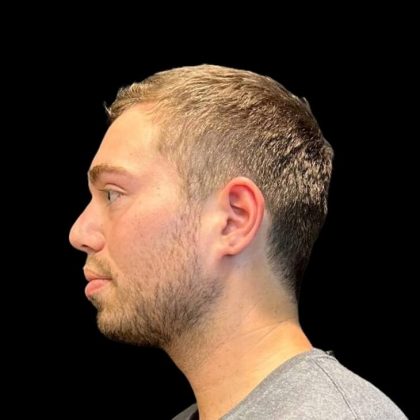 Rhinoplasty Before & After Patient #8159