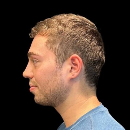 Rhinoplasty Before & After Patient #8159