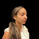 Rhinoplasty Before & After Patient #5387