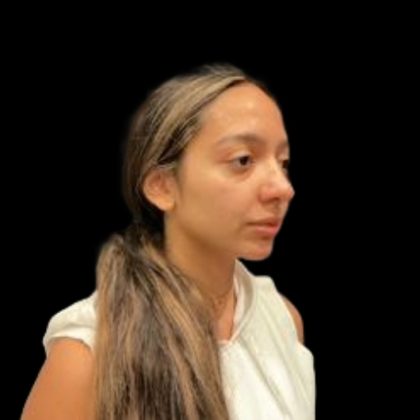 Rhinoplasty Before & After Patient #5387