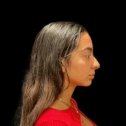 Rhinoplasty Before & After Patient #5387