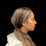 Rhinoplasty Before & After Patient #5387