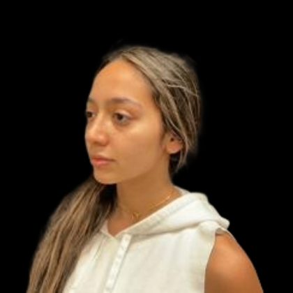 Rhinoplasty Before & After Patient #5387