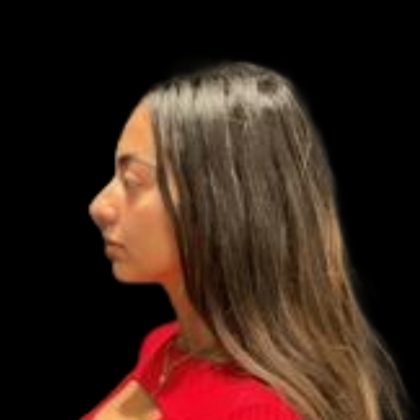 Rhinoplasty Before & After Patient #5387
