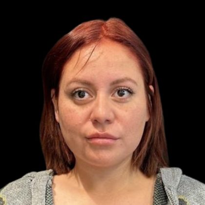 Rhinoplasty Before & After Patient #6852