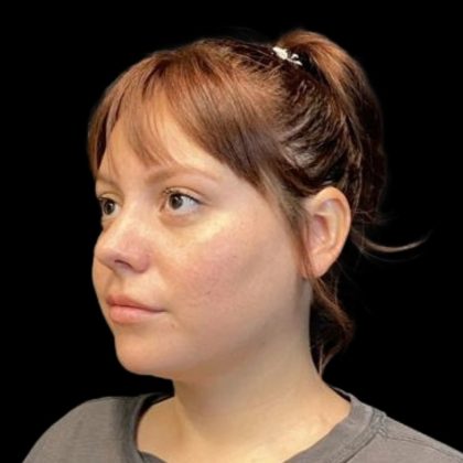 Rhinoplasty Before & After Patient #6852