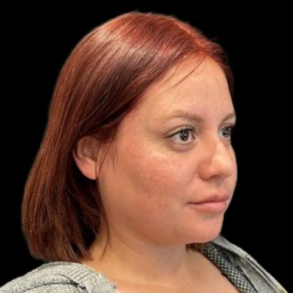 Rhinoplasty Before & After Patient #6852