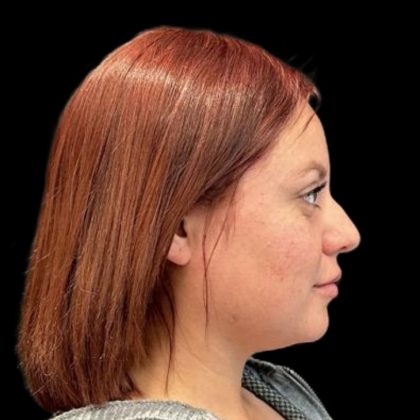 Rhinoplasty Before & After Patient #6852