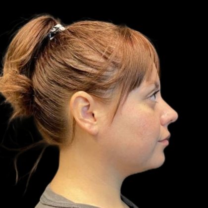 Rhinoplasty Before & After Patient #6852
