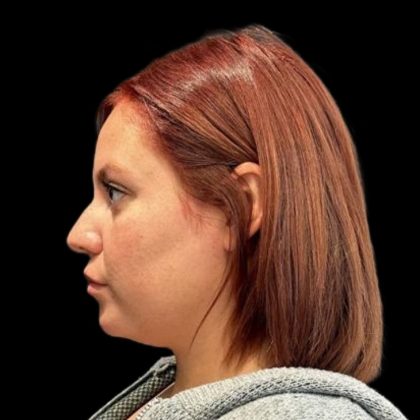 Rhinoplasty Before & After Patient #6852