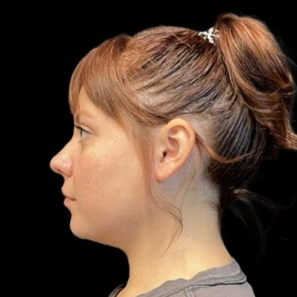 Rhinoplasty Before & After Patient #6852
