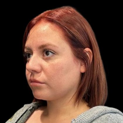 Rhinoplasty Before & After Patient #6852