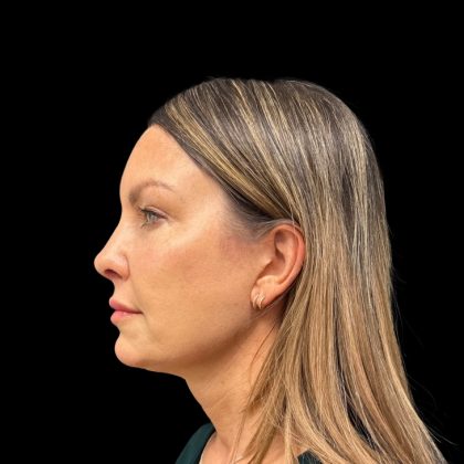 Rhinoplasty Before & After Patient #9157
