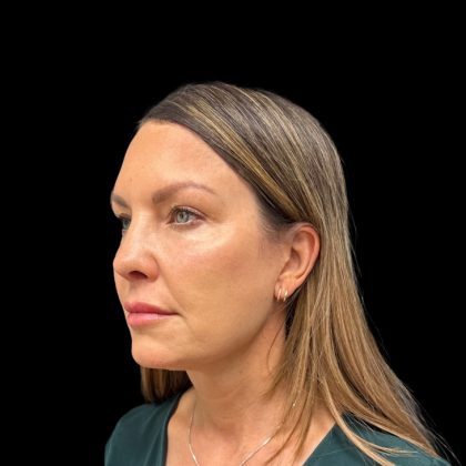 Rhinoplasty Before & After Patient #9157