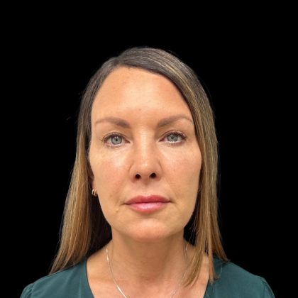 Rhinoplasty Before & After Patient #9157