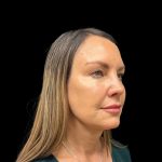 Rhinoplasty Before & After Patient #9157