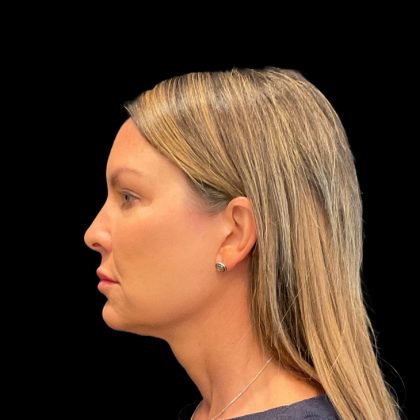 Rhinoplasty Before & After Patient #9157