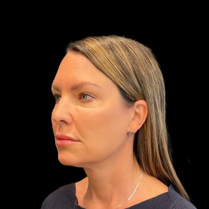 Rhinoplasty Before & After Patient #9157