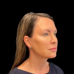 Rhinoplasty Before & After Patient #9157