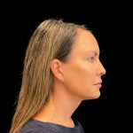 Rhinoplasty Before & After Patient #9157