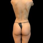 Rib Repositioning Before & After Patient #5586