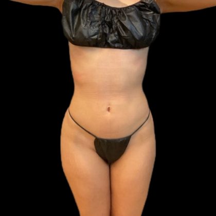 Rib Repositioning Before & After Patient #5586