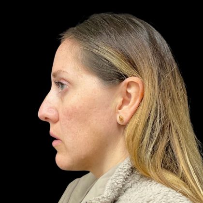 Sculptra Before & After Patient #9212