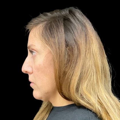 Sculptra Before & After Patient #9212