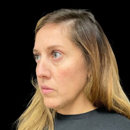 Sculptra Before & After Patient #9212