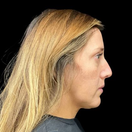 Sculptra Before & After Patient #9212