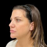 Sculptra Before & After Patient #9229