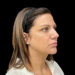 Sculptra Before & After Patient #9229