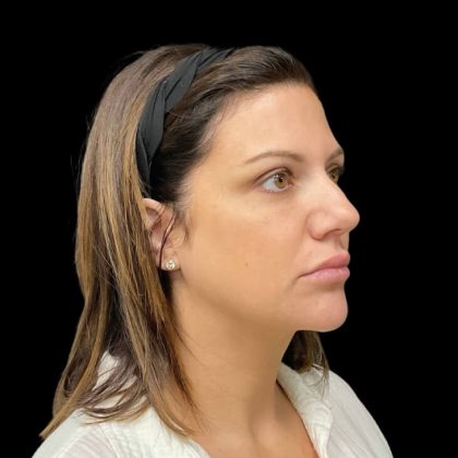 Sculptra Before & After Patient #9229
