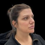 Sculptra Before & After Patient #9229