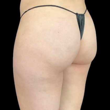 Aveli (Cellulite Removal) Before & After Patient #9242
