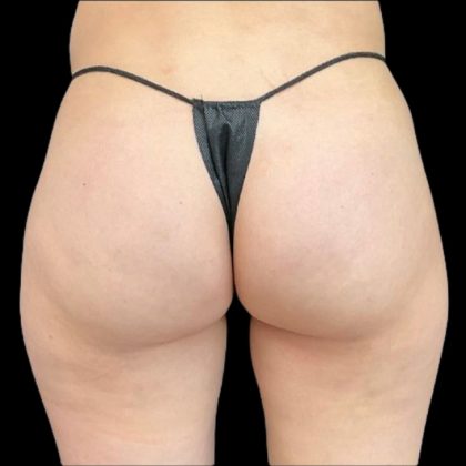 Aveli (Cellulite Removal) Before & After Patient #9242