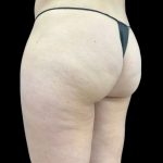 Aveli (Cellulite Removal) Before & After Patient #9242