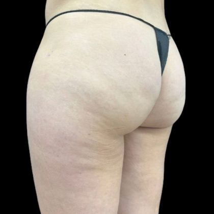 Aveli (Cellulite Removal) Before & After Patient #9242