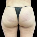 Aveli (Cellulite Removal) Before & After Patient #9242