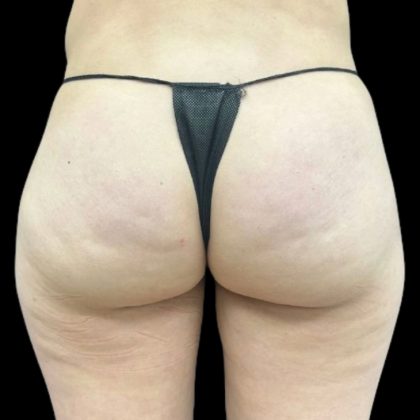 Aveli (Cellulite Removal) Before & After Patient #9242