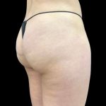 Aveli (Cellulite Removal) Before & After Patient #9242
